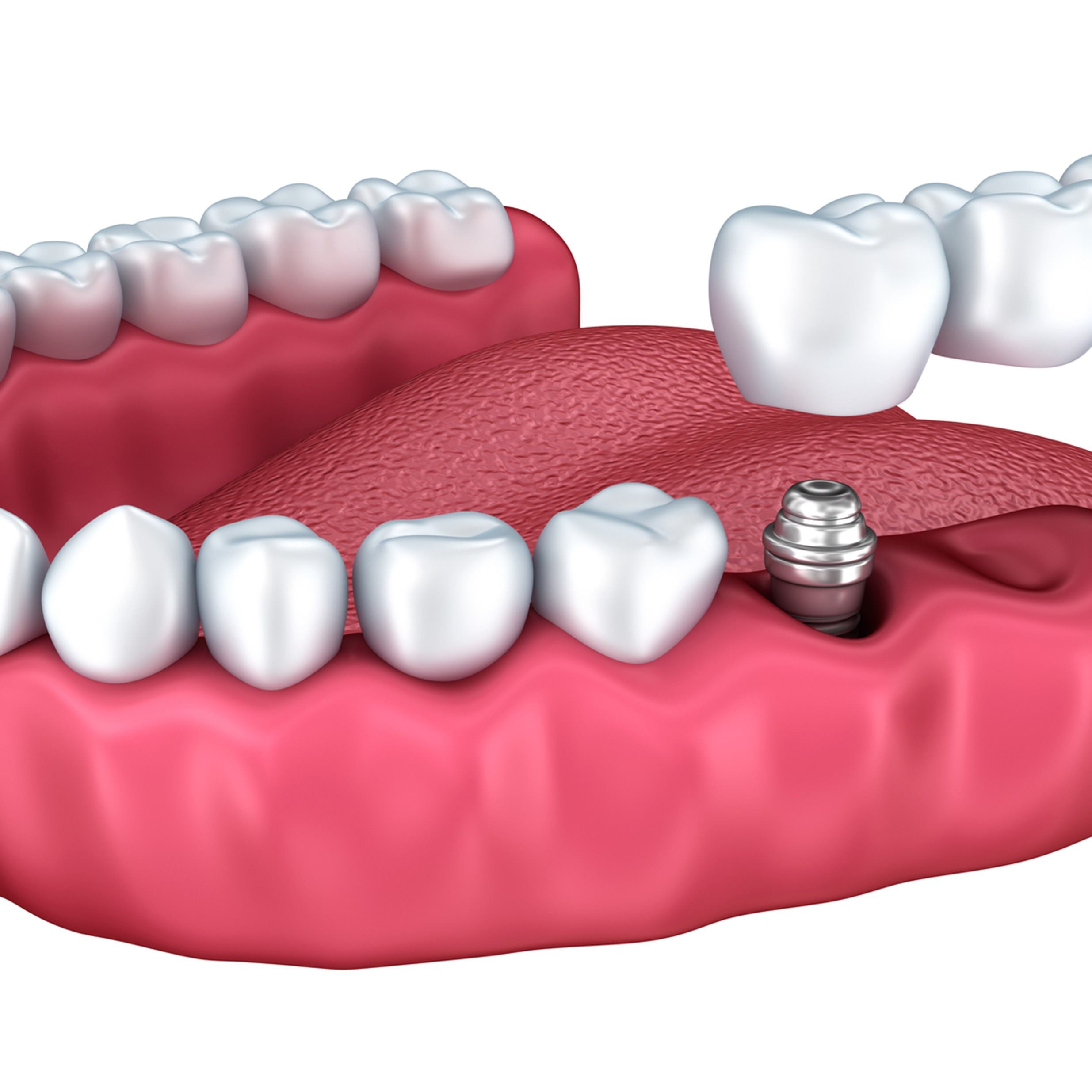 dentadura_dientes_ilustracion_placa_odontologia