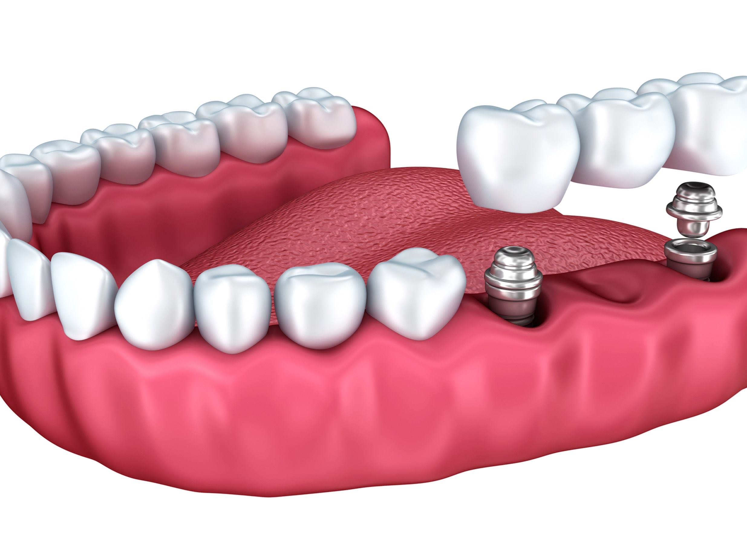 dentadura_dientes_ilustracion_placa_odontologia